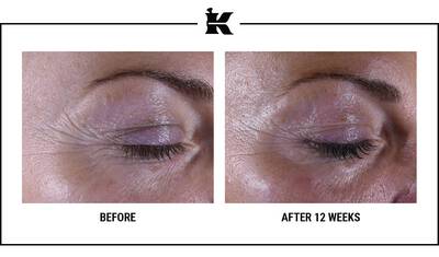 Before and After Super Multi-Corrective Eye Zone Treatment