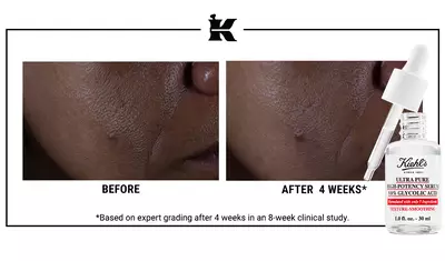 Before and After Glycolic Acid Serum