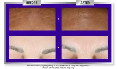 Before and After Retinol Serum