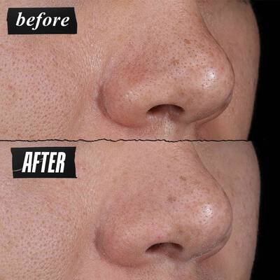 A side-by-side comparison showing close-up images of skin texture. The left image is labeled "BEFORE" and shows more visible pores, while the right image is labeled "AFTER" and shows visibly reduced pores.