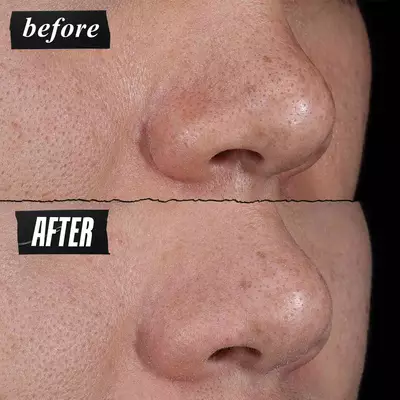 A side-by-side comparison showing close-up images of skin texture. The left image is labeled "BEFORE" and shows more visible pores, while the right image is labeled "AFTER" and shows visibly reduced pores.