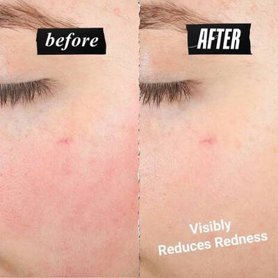 Side-by-side comparison labeled “before” and “after,” showing reduced redness on the skin. Text reads “Visibly Reduces Redness.”