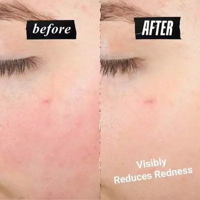 Side-by-side comparison labeled “before” and “after,” showing reduced redness on the skin. Text reads “Visibly Reduces Redness.”