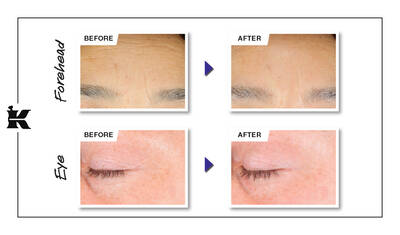 Before and After Retinol Serum