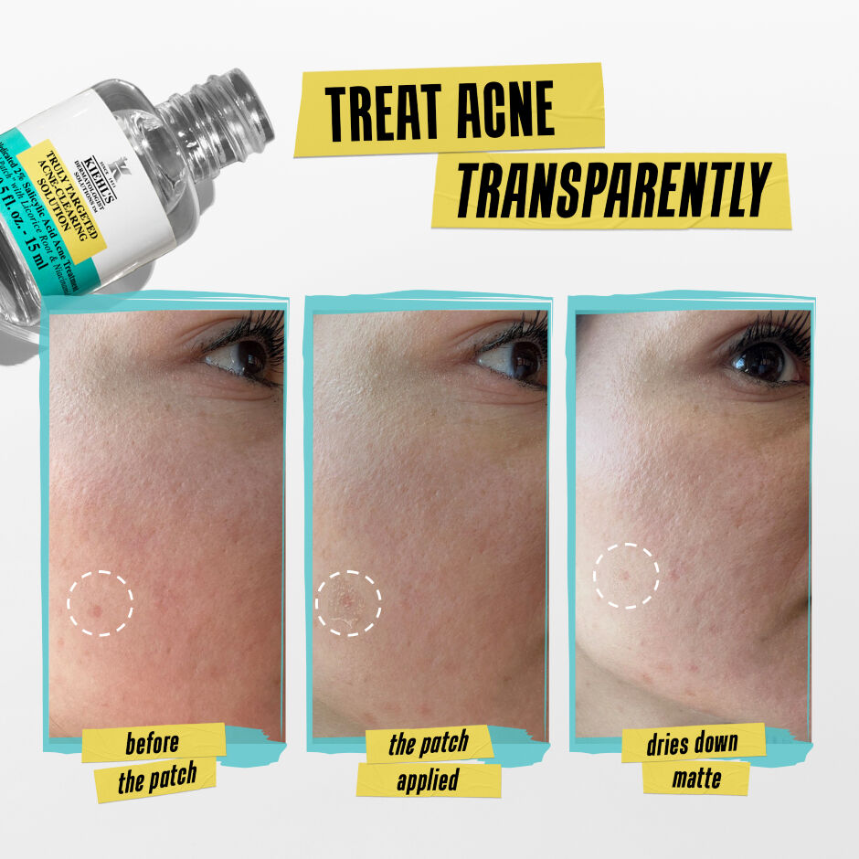 Acne clearing 2025
