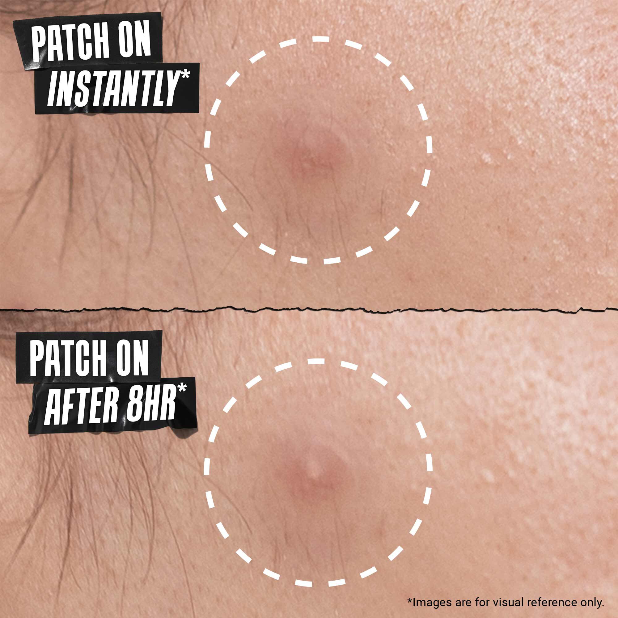 Truly Targeted Overnight Patch for Blemish-Prone Skin