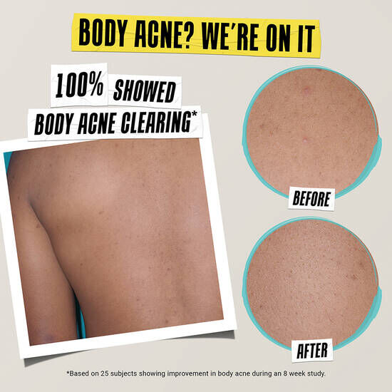 Lotion clarifiante experte pour le traitement et la prevention de l'acne