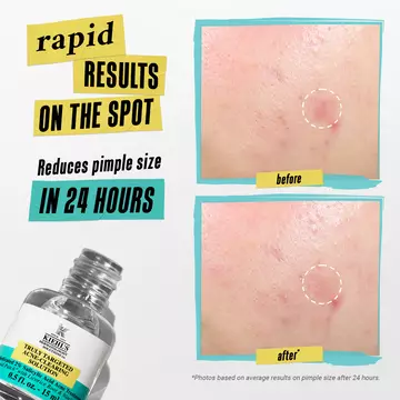 Truly Targeted Acne-Clearing Invisible Pimple Patch with 2% Salicylic Acid
