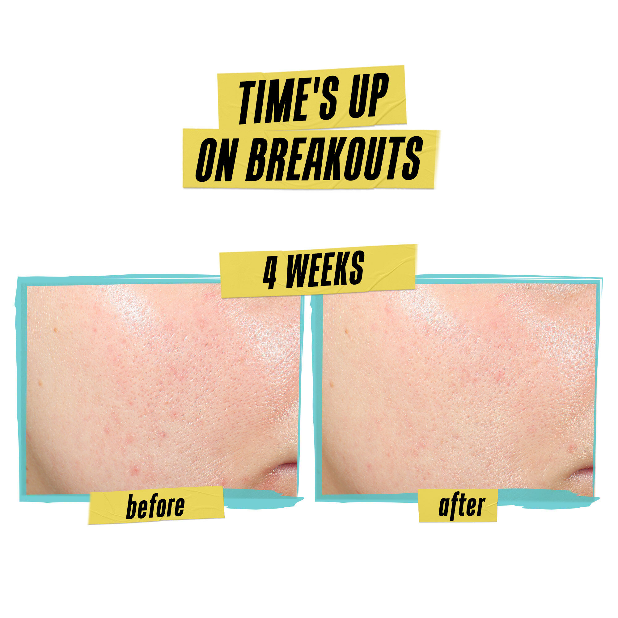 Lotion clarifiante experte pour le traitement et la prevention de l'acne