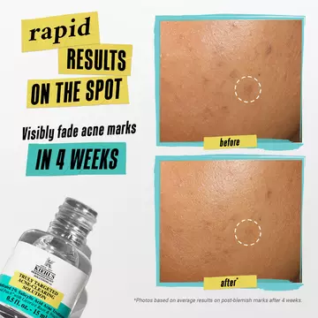 Truly Targeted Acne-Clearing Invisible Pimple Patch with 2% Salicylic Acid
